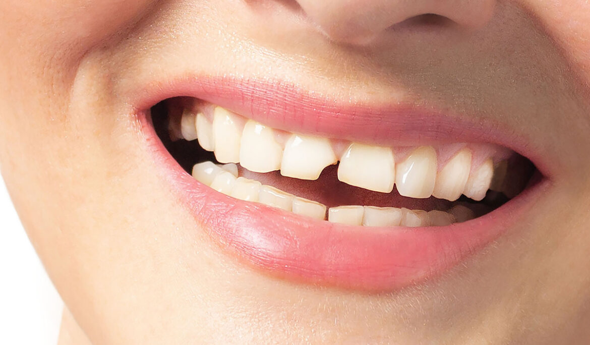Woman smiles with broken tooth. Need a Dentist. Close up photo white background.