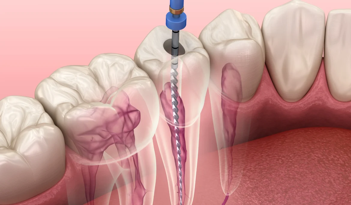 Endodontic root canal treatment process. Medically accurate tooth 3D illustration.