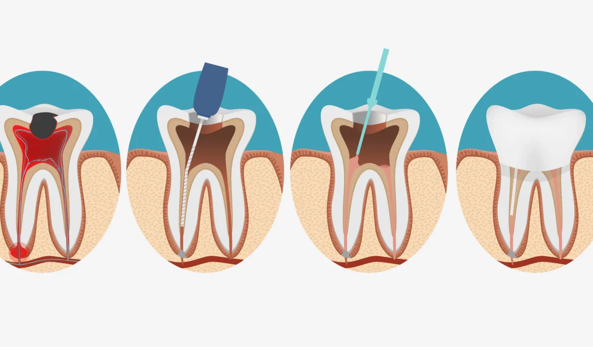 Root canal process