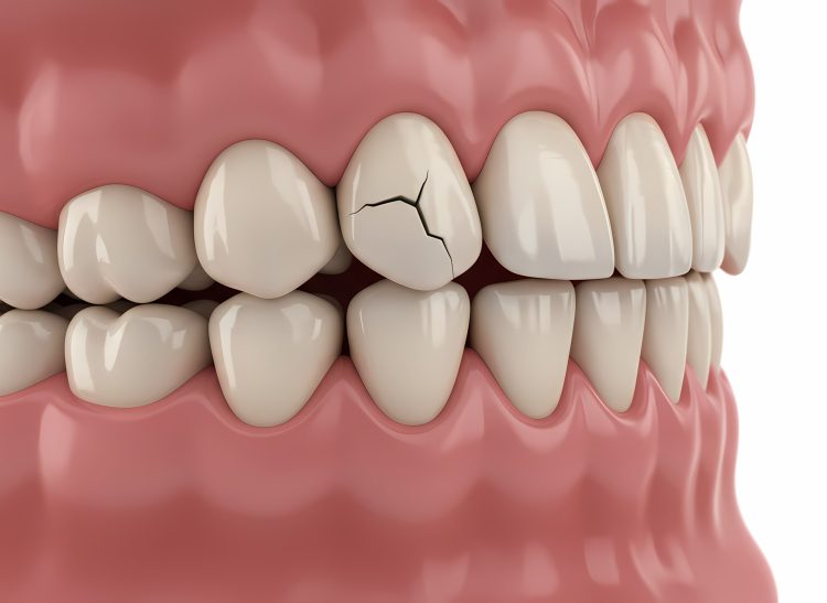Close up of cracked tooth in human mouth dental problem close up healthy teeth damaged enamel and gum line detail healthy gums and dental hygiene concept white background