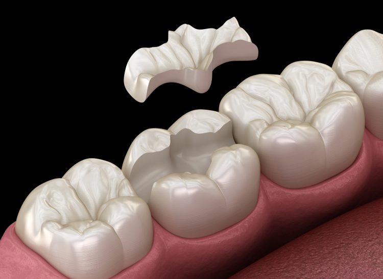 Inlay ceramic crown fixation over tooth. Medically accurate 3D illustration of human teeth treatment